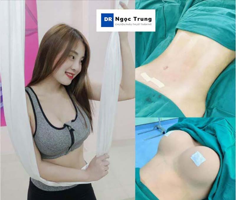 Phù thủy ngực bụng Dr Ngọc Trung giải đáp về Combo nâng cấp toàn diện vòng 1 & vòng 2