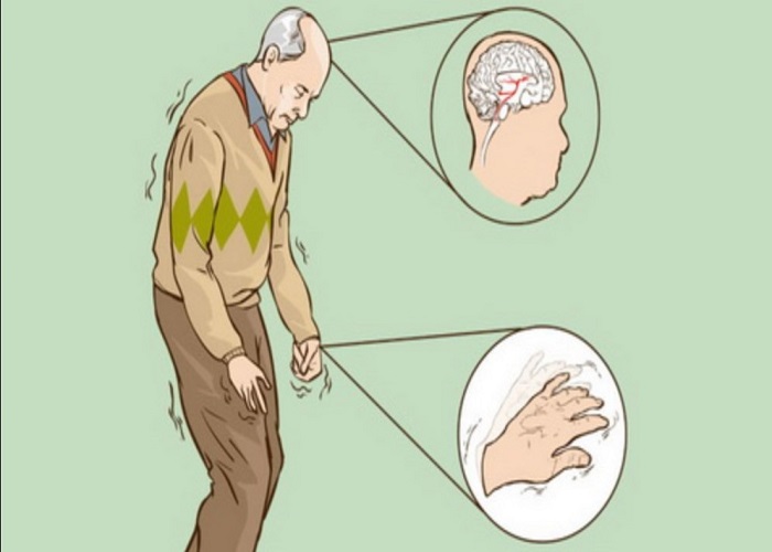 Chi tiết bệnh Parkinson theo y học cổ truyền