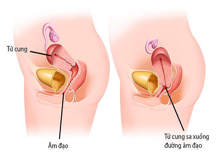 Giải đáp thắc mắc: Bị sa tử cung sau sinh phải làm sao?