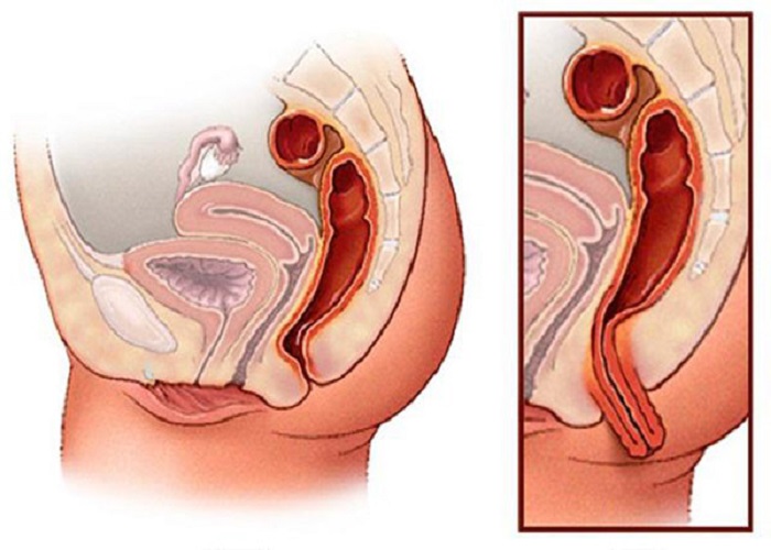 Giải đáp thắc mắc: Bị sa tử cung sau sinh phải làm sao?