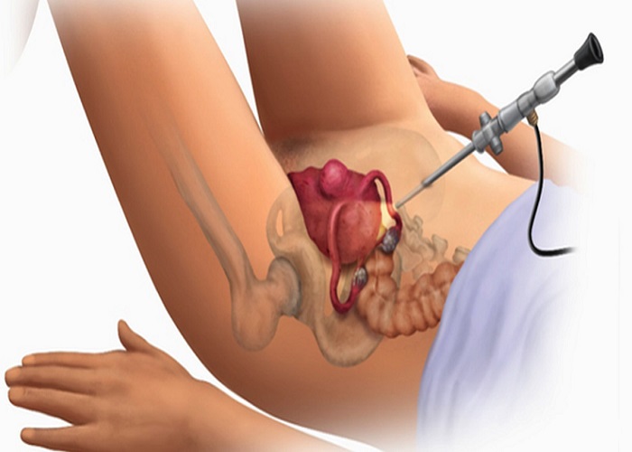 Giải đáp thắc mắc: Bị sa tử cung sau sinh phải làm sao?