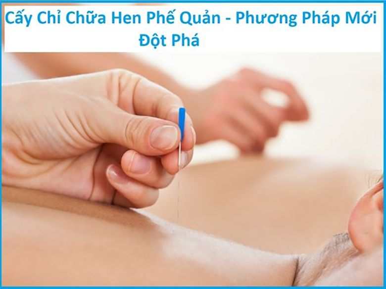 Cấy chỉ điều trị hen phế quản hiệu quả không? Chi phí như nào?