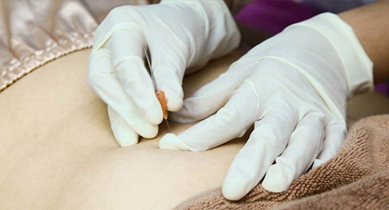 Cấy chỉ điều trị hen phế quản hiệu quả không? Chi phí như nào?