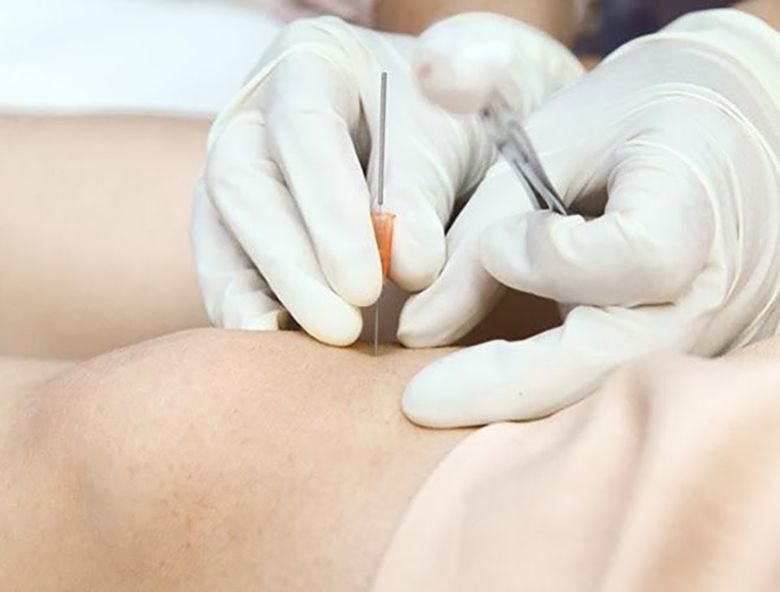 Cấy chỉ điều trị hen phế quản hiệu quả không? Chi phí như nào?