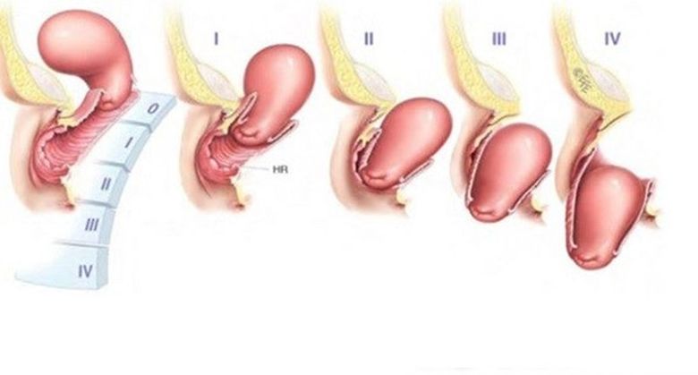 Sa tử cung có nguy hiểm không? Biến chứng thường gặp