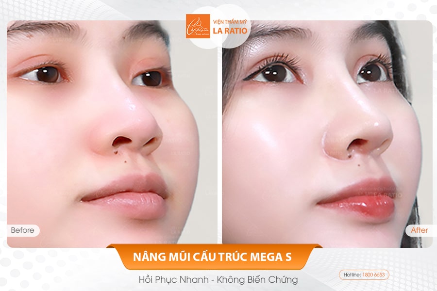 Nâng mũi phong thủy và những điều không nên bỏ lỡ