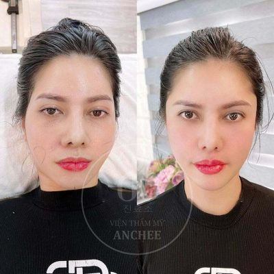 Anchee Clinic - Trung tâm spa chăm sóc sắc đẹp được giới trẻ bình chọn top đầu