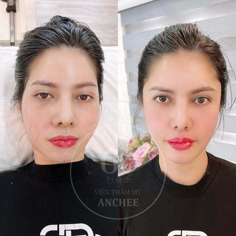 Anchee Clinic - Trung tâm spa chăm sóc sắc đẹp được giới trẻ bình chọn top đầu 