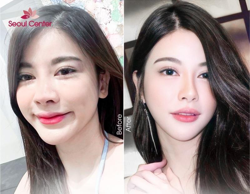Top 5 phương pháp nâng mũi an toàn, hiệu quả thẩm mỹ cao hiện nay