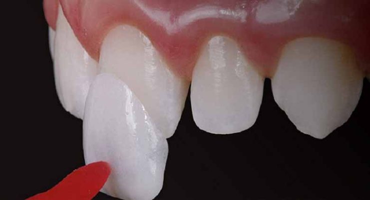 Top 3 địa chỉ dán sứ Veneer tốt nhất TPHCM