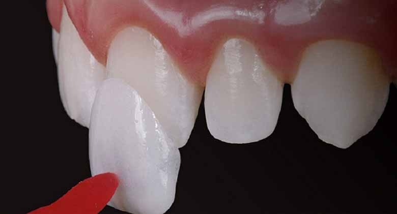 Top 3 địa chỉ dán sứ Veneer tốt nhất TPHCM