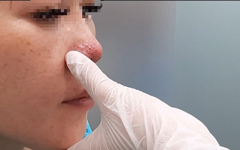 Tìm hiểu về tình trạng mũi bao xơ và cách phòng ngừa hiệu quả