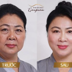Căng da mặt công nghệ cao tại Phòng Khám Mega Gangnam