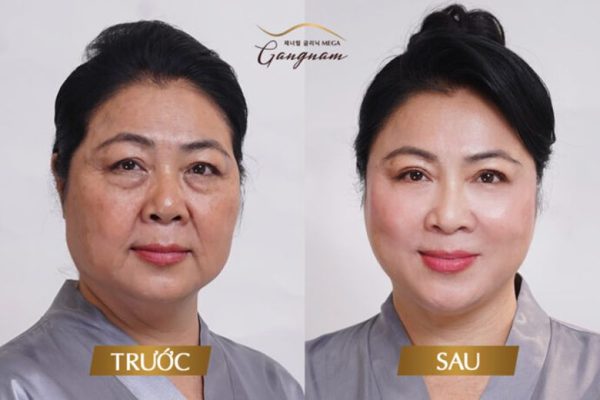 Căng da mặt công nghệ cao tại Phòng Khám Mega Gangnam