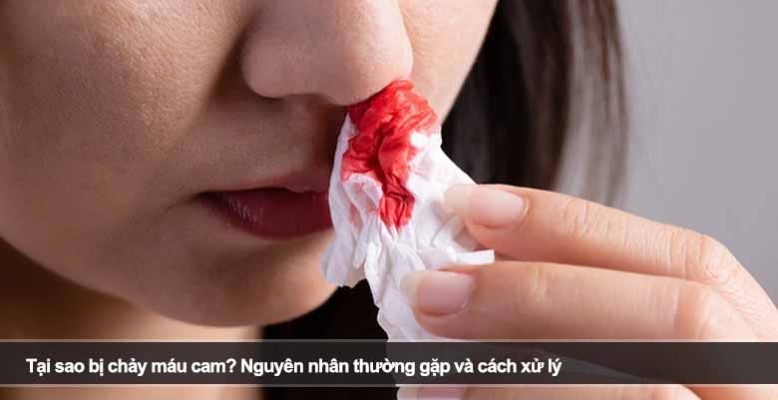 Tại sao bị chảy máu cam? Nguyên nhân thường gặp và cách xử lý