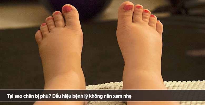 Tại sao chân bị phù? Dấu hiệu bệnh lý không nên xem nhẹ