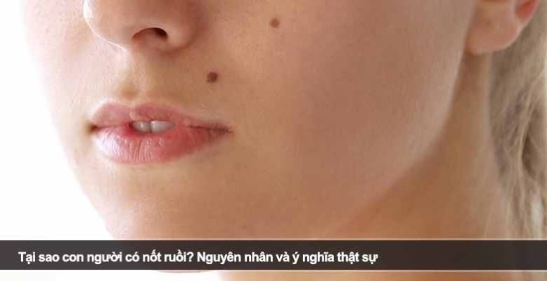 Tại sao con người có nốt ruồi? Nguyên nhân và ý nghĩa thật sự
