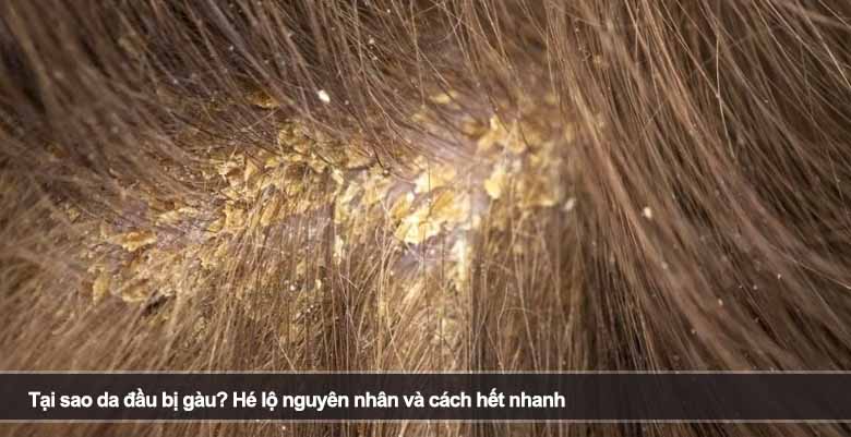 Tại sao da đầu bị gàu? Hé lộ nguyên nhân và cách hết nhanh